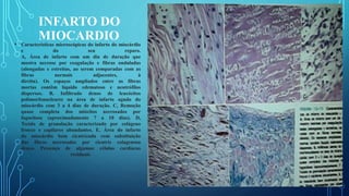 INFARTO DO
MIOCARDIO• Características microscópicas do infarto do miocárdio
e do seu reparo.
A, Área de infarto com um dia de duração que
mostra necrose por coagulação e fibras onduladas
(alongadas e estreitas, ao serem comparadas com as
fibras normais adjacentes, à
direita). Os espaços ampliados entre as fibras
mortas contêm líquido edematoso e neutrófilos
dispersos. B, Infiltrado denso de leucócitos
polimorfonucleares na área de infarto agudo do
miocárdio com 3 a 4 dias de duração. C, Remoção
quase completa dos miócitos necrosados por
fagocitose (aproximadamente 7 a 10 dias). D,
Tecido de granulação caracterizado por colágeno
frouxo e capilares abundantes. E, Área do infarto
do miocárdio bem cicatrizada com substituição
das fibras necrosadas por cicatriz colagenosa
densa. Presença de algumas células cardíacas
residuais.
 