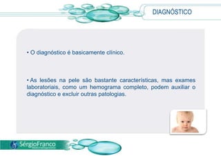 DIAGNÓSTICO
• O diagnóstico é basicamente clínico.
• As lesões na pele são bastante características, mas exames
laboratoriais, como um hemograma completo, podem auxiliar o
diagnóstico e excluir outras patologias.
 