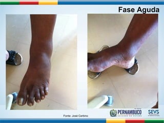 Fase Aguda 
Fonte: José Cerbino 
 