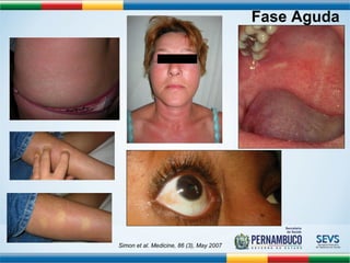 Simon et al. Medicine, 86 (3), May 2007 
Fase Aguda 
 