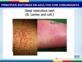 PRINCIPAIS SINTOMAS EM ADULTOS COM CHIKUNGUNYA 
 