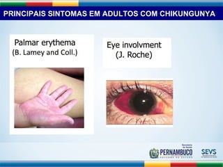 PRINCIPAIS SINTOMAS EM ADULTOS COM CHIKUNGUNYA 
 