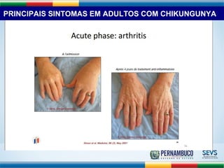 PRINCIPAIS SINTOMAS EM ADULTOS COM CHIKUNGUNYA 
 