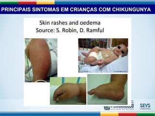 PRINCIPAIS SINTOMAS EM CRIANÇAS COM CHIKUNGUNYA 
 