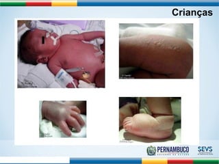 Crianças 
Ernould S et al. Arch Ped 2008;15:253-62 
 