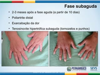 • 2-3 meses após a fase aguda (a partir de 10 dias) 
• Poliartrite distal 
• Exarcebação da dor 
• Tenosinovite hipertrófica subaguda (tornozelos e punhos) 
Simon F et coll. Medicine 2007;86: 123-37 
Fase subaguda 
 