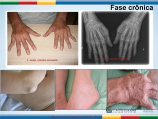 Simon F et coll. Medicine 2007;86: 123-37 
Fase crônica 
 