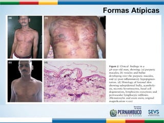Formas Atípicas 
Ernould S et al. Arch Ped 2008;15:253-62 
 