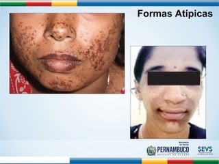 Formas Atípicas 
Ernould S et al. Arch Ped 2008;15:253-62 
 