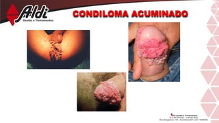 CONDILOMA ACUMINADO
 
