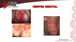 HERPES GENITAL
 