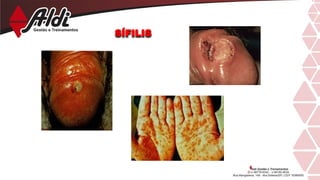 SÍFILIS
 