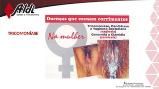 TRICOMONÍASE
 