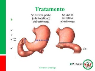 Tratamento
Cirúrgico
 É o mais importante e único curativo;
 Gastrectomia total ou parcial;
 Exige a remoção completa do tumor com margens
distais e proximais de 5 cm a partir do tumor visível.
 Defende-se a ressecção dos linfonodos retroperitoneais;
Câncer de Estômago
 