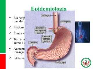 Epidemiologia
 É a neoplasia mais comum do TGI em todo o
mundo;
 Predomina no sexo masculino;
 É mais comum a partir dos 50 anos;
 Tem alta incidências em países orientais
como o Japão;
 Aumento da incidência do câncer na
transição esôfago gástrica.
 Alta incidência na classe social mais baixa
Câncer de Estômago
 