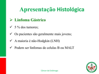Apresentação Histológica
 Linfoma Gástrico
 5 % dos tumores;
 Os pacientes são geralmente mais jovens;
 A maioria é não-Hodgkin (LNH)
 Podem ser linfomas de celulas B ou MALT
Câncer de Estômago
 