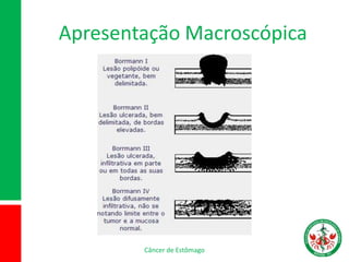 Apresentação Macroscópica
Câncer de Estômago
 