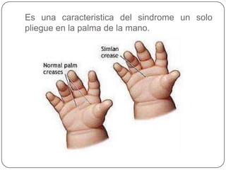 Es una caracteristica del sindrome un solo
pliegue en la palma de la mano.
 