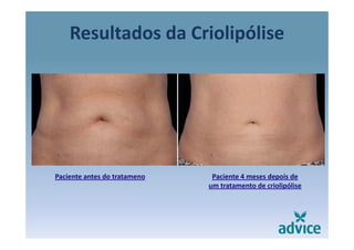 Resultados da Criolipólisep
Paciente antes do tratameno Paciente 4 meses depois de 
um tratamento de criolipólise
 