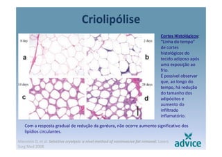 Criolipólisep
Cortes Histológicos:
“Linha do tempo”Linha do tempo  
de cortes 
histológicos do 
tecido adiposo após p p
uma exposição ao 
frio. 
É possível observar 
que, ao longo do 
tempo, há redução 
do tamanho dos 
adipócitos e 
aumento do 
infiltrado 
fl óinflamatório.
Com a resposta gradual de redução da gordura, não ocorre aumento significativo dos 
lipídios circulanteslipídios circulantes.
Manstein D, et al. Selective cryolysis: a nivel method of noninvasive fat removal. Lasers 
Surg Med 2008.
 