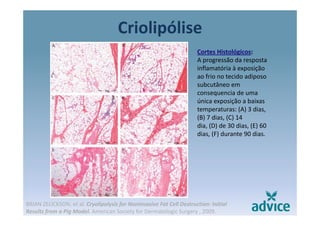 Criolipólisep
Cortes Histológicos:
A progressão da respostaA progressão da resposta 
inflamatória à exposição 
ao frio no tecido adiposo 
subcutâneo em 
consequencia de uma 
única exposição a baixas 
temperaturas: (A) 3 dias, 
(B) 7 dias, (C) 14
dia, (D) de 30 dias, (E) 60 
dias, (F) durante 90 dias.
BRIAN ZELICKSON, et al. Cryolipolysis for Noninvasive Fat Cell Destruction: Initial 
Results from a Pig Model. American Society for Dermatologic Surgery , 2009.
 