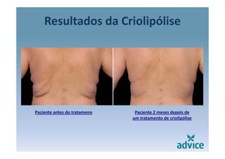 Resultados da Criolipólisep
Paciente antes do tratameno Paciente 2 meses depois de 
um tratamento de criolipólise
 
