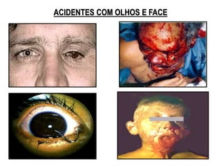 ACIDENTES COM OLHOS E FACE
 