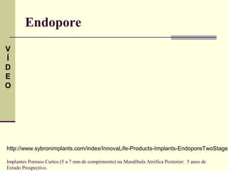 Endopore
V
Í
D
E
O




http://www.sybronimplants.com/index/InnovaLife-Products-Implants-EndoporeTwoStage

Implantes Porosos Curtos (5 a 7 mm de comprimento) na Mandíbula Atrófica Posterior: 5 anos de
Estudo Prospectivo.
 