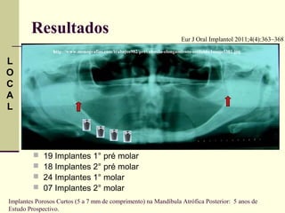 Resultados                                                         Eur J Oral Implantol 2011;4(4):363–368
                http://www.monografias.com/trabajos902/prevalencia-elongamiento-estiloide/Image5381.jpg

L
O
C
A
L




            19 Implantes 1° pré molar
            18 Implantes 2° pré molar
            24 Implantes 1° molar
            07 Implantes 2° molar
Implantes Porosos Curtos (5 a 7 mm de comprimento) na Mandíbula Atrófica Posterior: 5 anos de
Estudo Prospectivo.
 