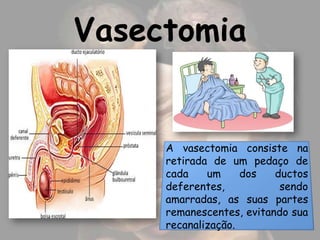 Vasectomia


     A vasectomia consiste na
     retirada de um pedaço de
     cada    um     dos   ductos
     deferentes,           sendo
     amarradas, as suas partes
     remanescentes, evitando sua
     recanalização.
 