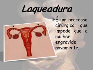 Laqueadura
      É um processo
       cirúrgico que
       impede que a
       mulher
       engravide
       novamente.
 