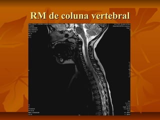 RRMM ddee ccoolluunnaa vveerrtteebbrraall 
 