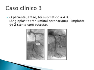    O paciente, então, foi submetido a ATC
    (Angioplastia tranluminal coronariana) – implante
    de 2 stents com sucesso.
 