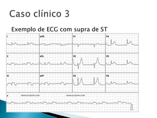 Exemplo de ECG com supra de ST
 