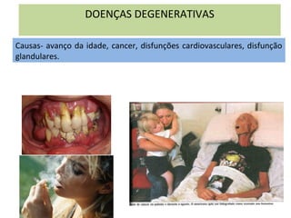 DOENÇAS DEGENERATIVAS
Causas- avanço da idade, cancer, disfunções cardiovasculares, disfunção
glandulares.
 