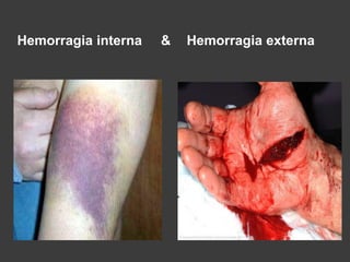 Hemorragia interna & Hemorragia externa
 