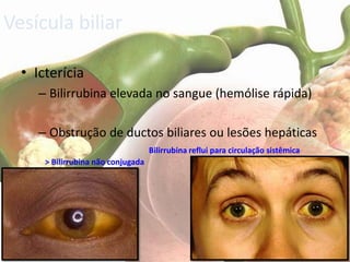 Vesícula biliar

  • Icterícia
     – Bilirrubina elevada no sangue (hemólise rápida)

     – Obstrução de ductos biliares ou lesões hepáticas
                                    Bilirrubina reflui para circulação sistêmica
      > Bilirrubina não conjugada
 