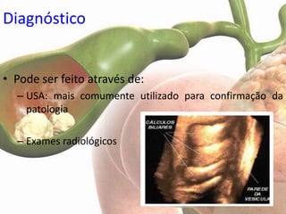Diagnóstico


• Pode ser feito através de:
  – USA: mais comumente utilizado para confirmação da
    patologia

  – Exames radiológicos
 