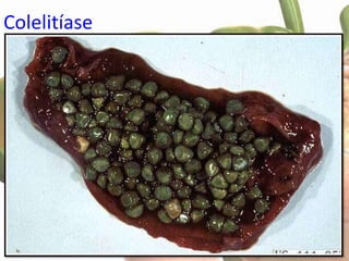 Colelitíase
 