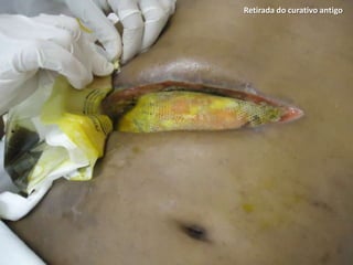 Retirada do curativo antigo
 