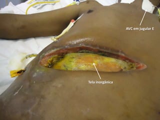 AVC em jugular E




Tela inorgânica
 