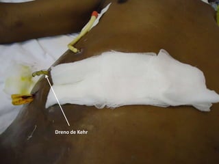 Dreno de Kehr
 