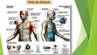 TIPOS DE DENGUE
 