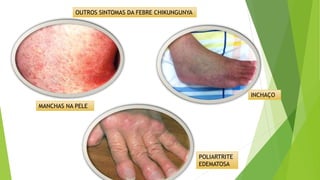 OUTROS SINTOMAS DA FEBRE CHIKUNGUNYA
POLIARTRITE
EDEMATOSA
INCHAÇO
MANCHAS NA PELE
 