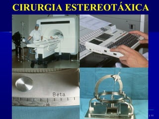 CIRURGIA ESTEREOTÁXICA
le




     Title




                    Advances in Surgery l September 9, 2006 l 11
 