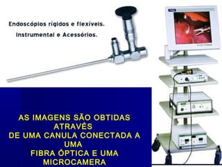 AS IMAGENS SÃO OBTIDAS
         ATRAVÉS
DE UMA CANULA CONECTADA A
           UMA
    FIBRA ÓPTICA E UMA
       MICROCAMERA
 
