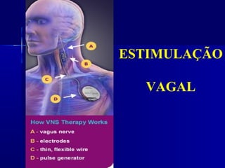 ESTIMULAÇÃO

  VAGAL
 