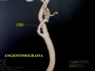 ANGIOTOMOGRAFIA
 