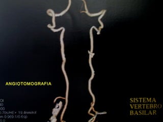 ANGIOTOMOGRAFIA
 