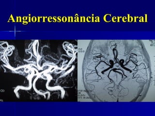 Angiorressonância Cerebral
 